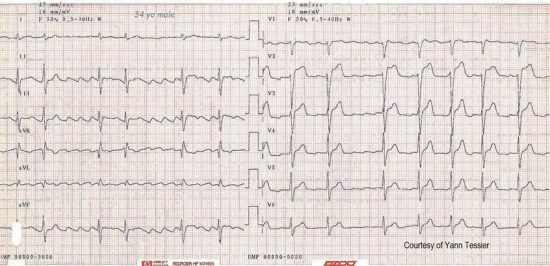 ecg in series 4